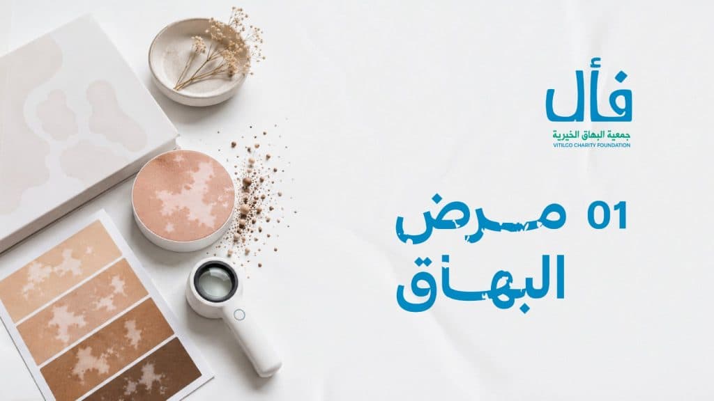 ما هو البهاق؟ وما علاجة؟