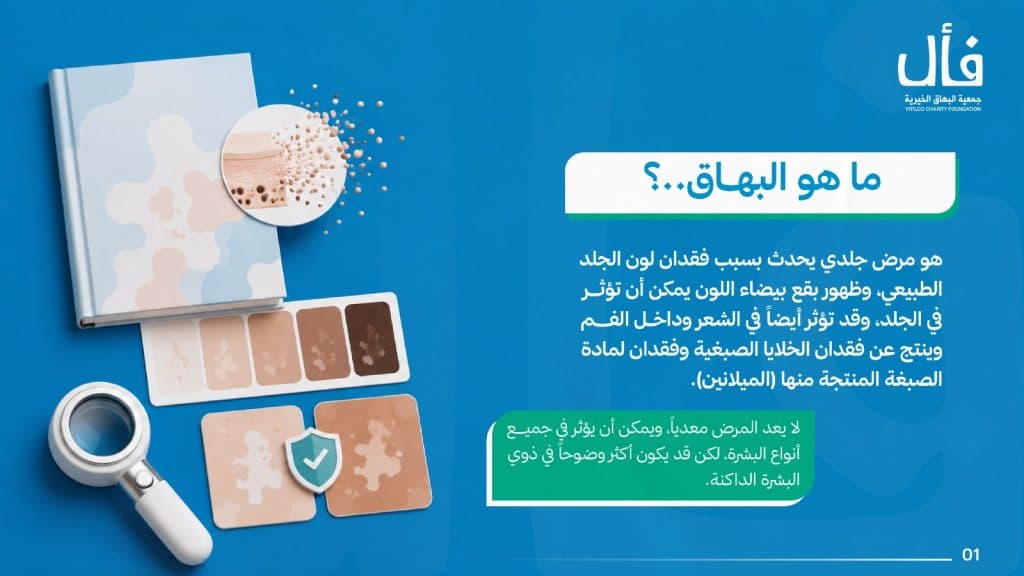 ما هو البهاق؟ وما علاجة؟